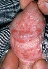 secreción do pene debido a candidiasis
